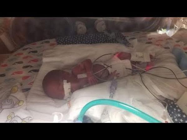 فيديو : طفل ينجو بعدما ولد بوزن 360 غرام