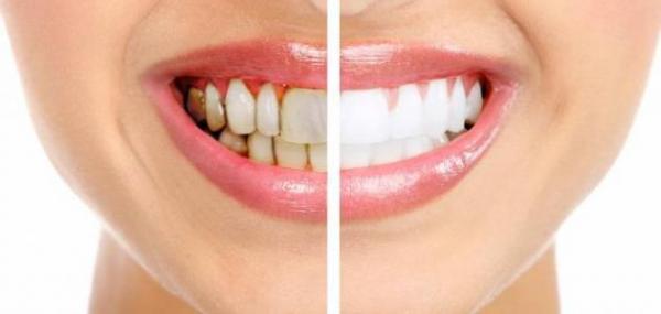 10 طرق طبيعية لإزالة جير الأسنان