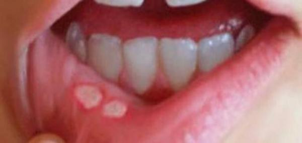 كيفية تجنب الإصابة بقرحة الفم