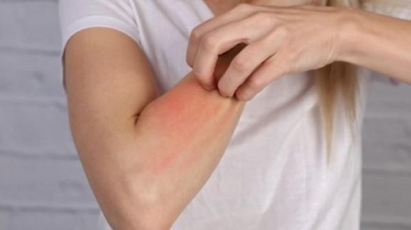 هل تعاني من حساسية الجلد؟ .. تعرف على هذه العلاجات الطبيعية