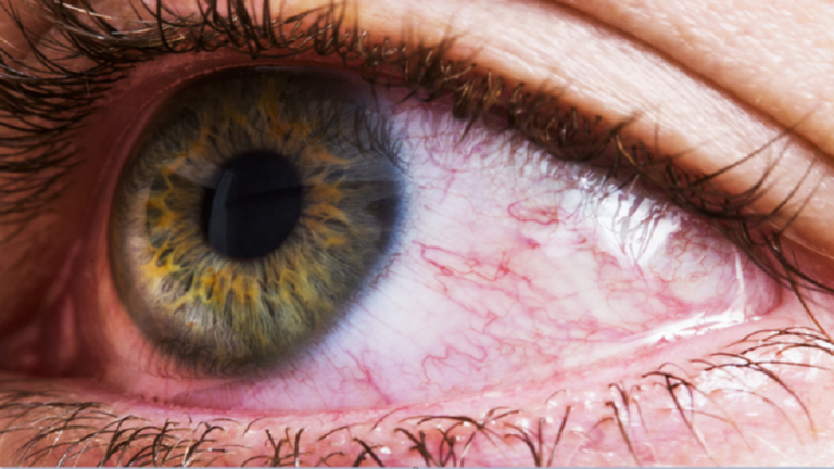 هل يمكن أن تسبب الإصابة بـ كوفيد19 فقدان البصر؟