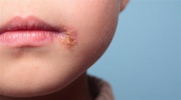 مرض فيروسي شديد العدوى بين الأطفال