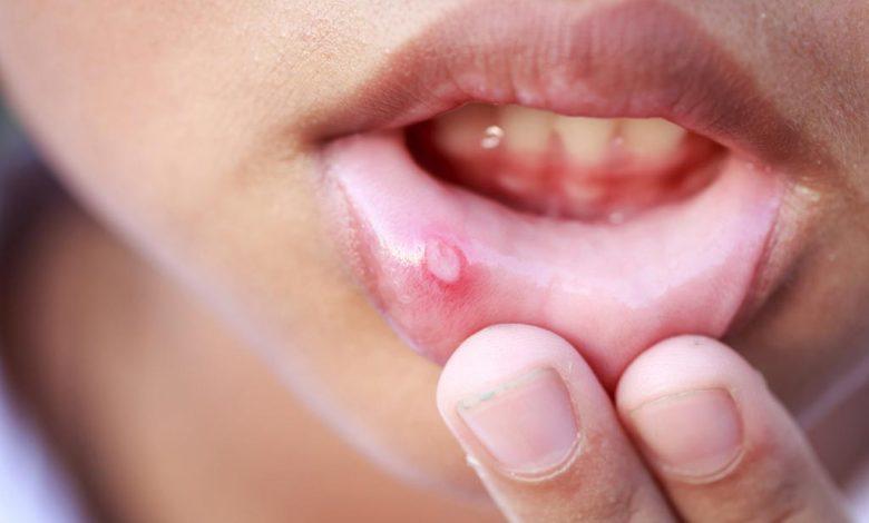 تقرحات الفم المزعجة عند الأطفال.. أسبابها وعلاجها