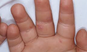 متخصصون: أعراض متلازمة اليد والفم والقدم متفاوتة في شدتها لكنها غير مقلقة
