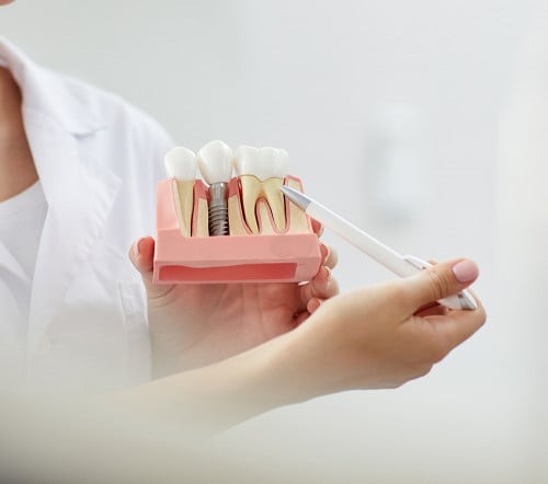 زراعة الأسنان.. بين بريق التجميل وحاجة المريض إليها