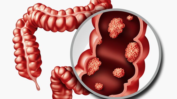 دراسة جديدة تكشف أكبر عامل خطر لسرطان القولون لدى الشباب