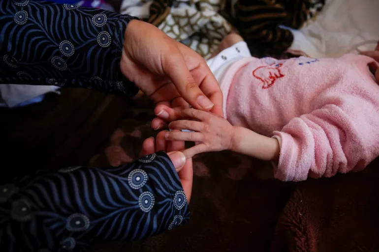 ولادة طفلة من دون دماغ مع تزايد تشوه الأجنة في غزة
