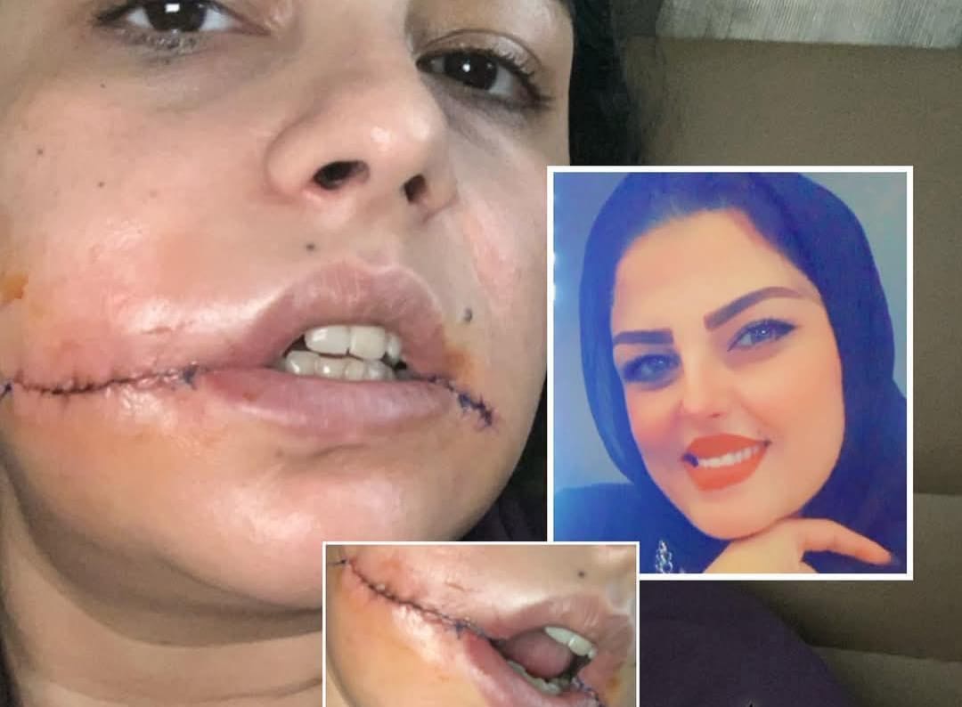 رفضته فشوّه وجهها… منى تستغيث: المجرم حر طليق ويهدد بإنهاء حياتي