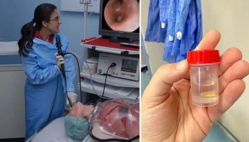 معجزة طبية: حبة ذرة تكاد تودي بحياة سيدة تركية لـ5 أشهر دون أن تدري