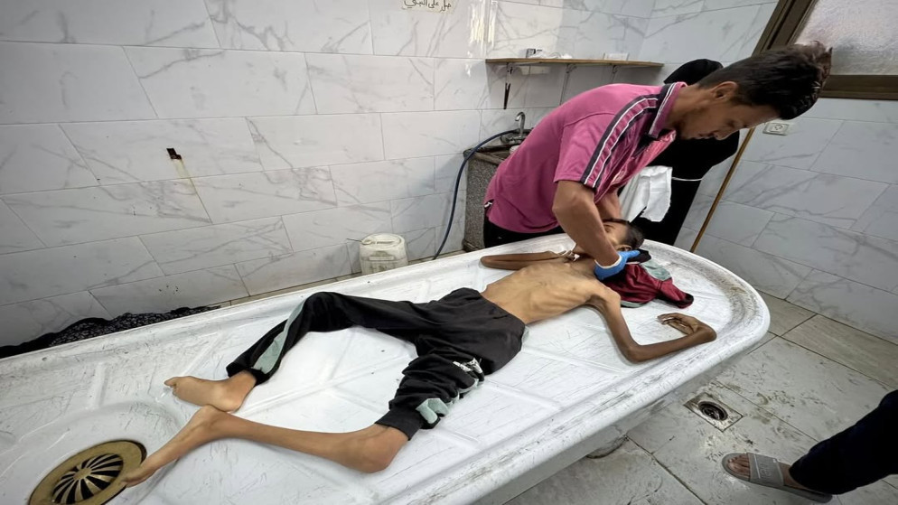 الحرب على غزة 10 شهداء في غزة نتيجة المجاعة وسوء التغذية بينهم 3 أطفال خلال 24 ساعة