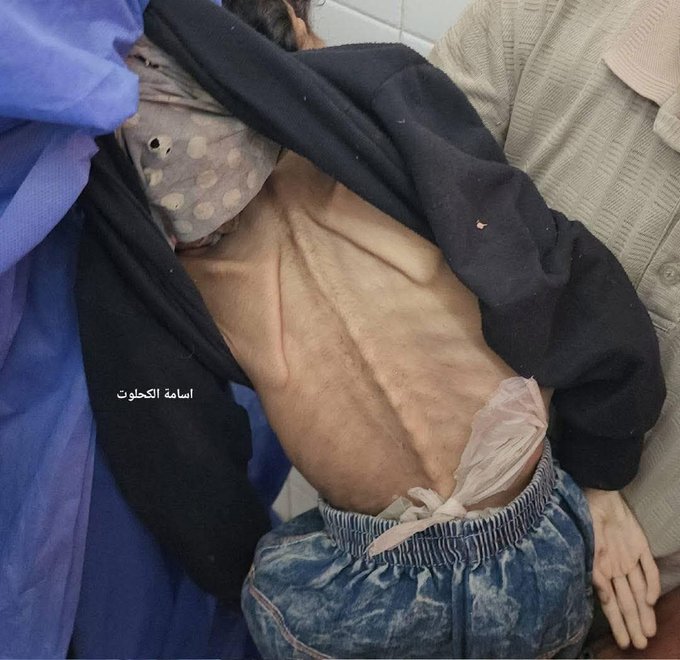 استشهاد طفلة رضيعة بسبب حرب التجويع الإسرائيلية