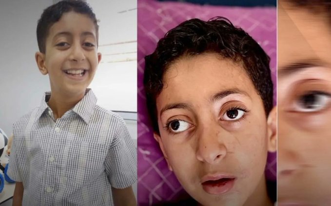طفل غزة يستعيد بصره ومشيته عبر الممر الطبي الأردني
