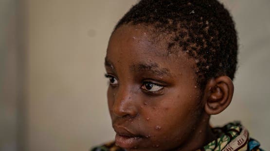 إصابات جديدة بجدري القرود بمزيد من الدول.. ووفيات في أفريقيا