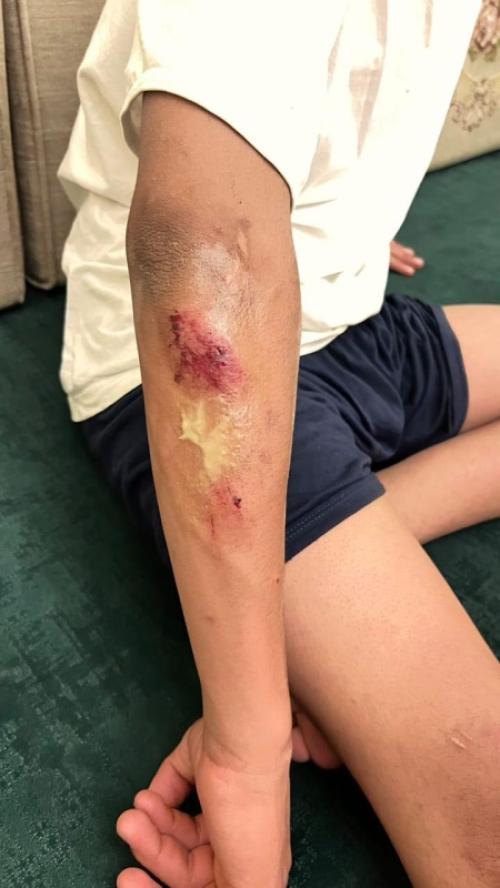 المفرق : كلاب ضالة تهاجم طفلاً في البادية الشمالية ..صور