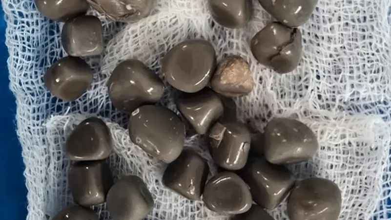 عملية دقيقة ومعقدة.. استخراج 58 حصوة من كلية مريض في مصر