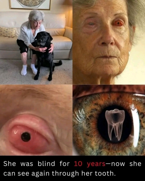 بعد 10 سنوات من العمى… امرأة كندية تستعيد بصرها عبر «سنّها» في جراحة تُذهل الطب!