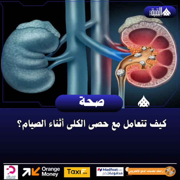 كيف تتعامل مع حصى الكلى أثناء الصيام؟