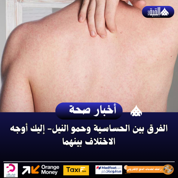 الفرق بين الحساسية وحمو النيل إليك أوجه الاختلاف بينهما