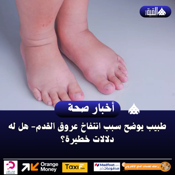طبيب يوضح سبب انتفاخ عروق القدم هل له دلالات خطيرة؟