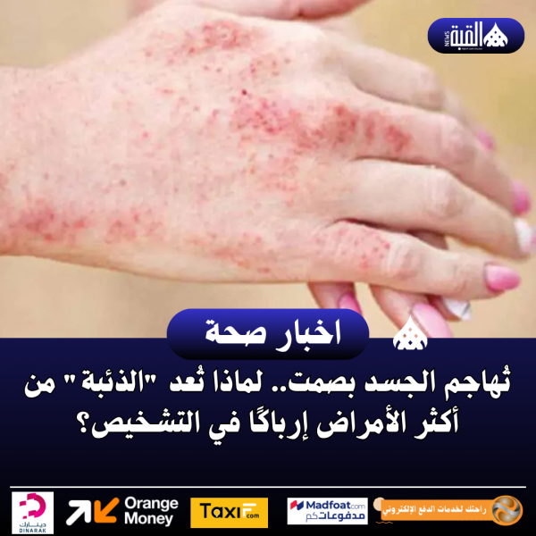 تُهاجم الجسد بصمت.. لماذا تُعد الذئبة من أكثر الأمراض إرباكًا في التشخيص؟