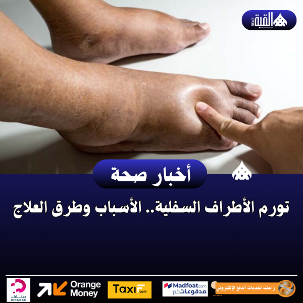 تورم الأطراف السفلية.. الأسباب وطرق العلاج